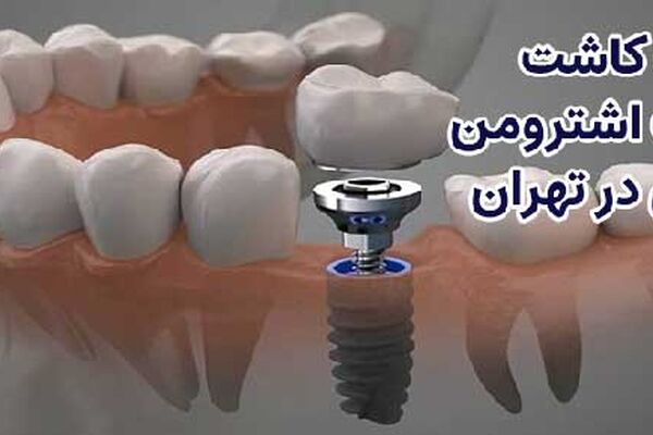 ایمپلنت سوئیسی اشترومن اقساطی در تهران